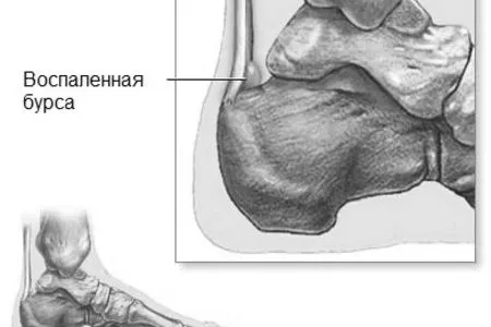 бурсит п'яти стопи що це таке лікування п'ятковий подпяточний гомілковостопний суглоб домашні умови