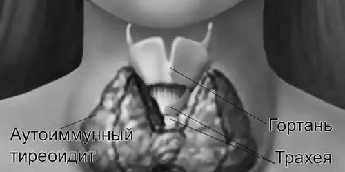 Що таке аутоімунний тиреоїдит - симптоми і причини хвороби, лікування щитовидної залози тиреоїдит