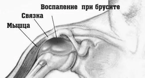 Бурсит плечового суглоба - причини, симптоми, лікування плечового