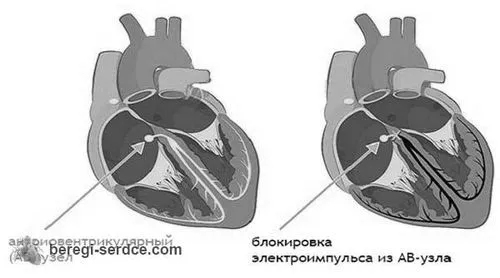 Чим небезпечна аритмія серця? Небезпеки при різних видах аритмій небезпека