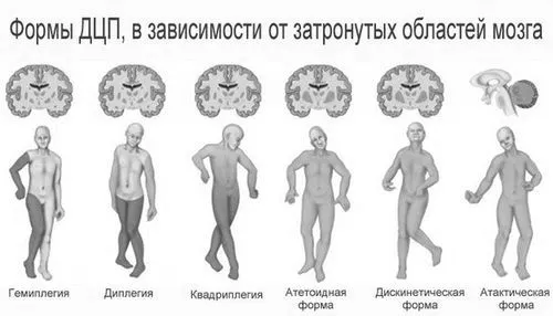 Дитячий церебральний параліч: причини, симптоми дцп, лікування лікування