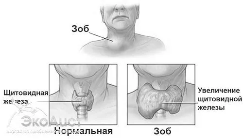 як лікувати дифузний зоб народними засобами