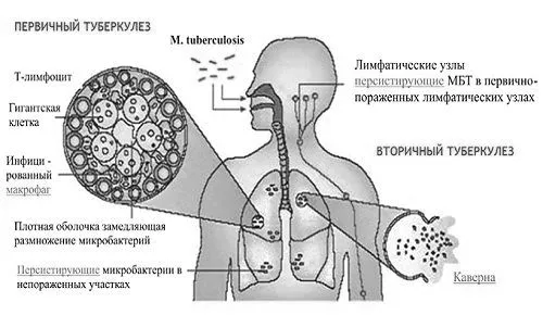чи можна вилікувати дисемінований туберкульоз