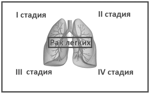 як лікувати рак легенів 3 стадія