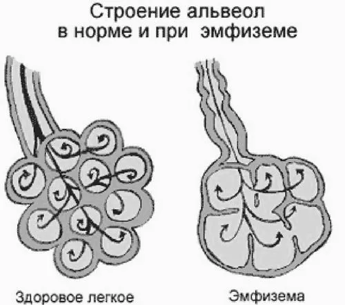 як лікувати емфізему легенів народними засобами