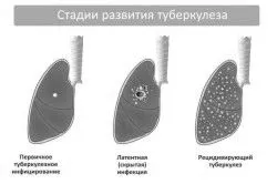 як лікувати розпад легенів