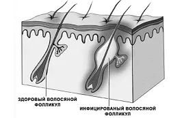 які антибіотики приймати при фурункулах