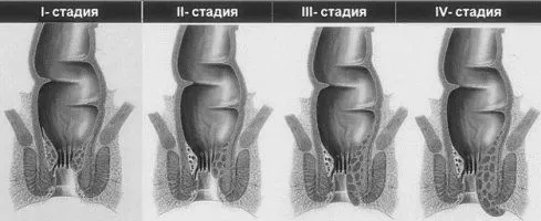 геморойні шишки