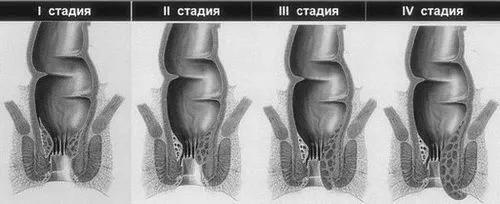 як позбутися від геморою народними засобами