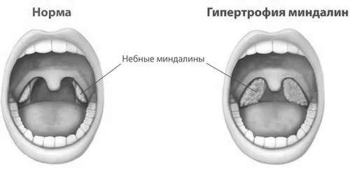 Гіпертрофія (збільшення) піднебінних мигдалин - ступеня, лікування збільшення