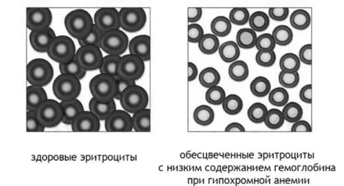 як лікувати гіпохромною анемію