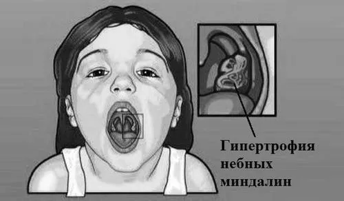 Гіпертрофія (збільшення) мигдалин у дітей 1, 2, 3, 4 ступеня ступеня