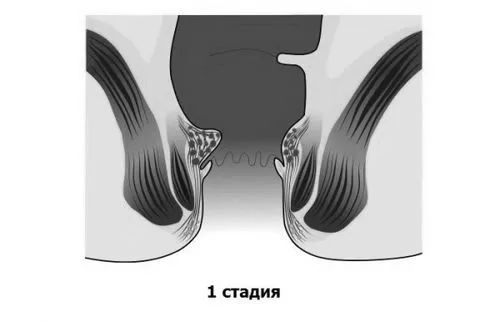хронічного