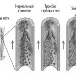 тахікардію
