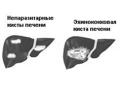 кіста
