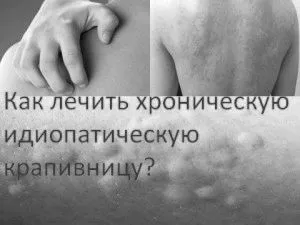 хронічна кропив'янка