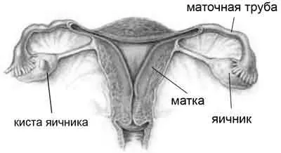 кіста