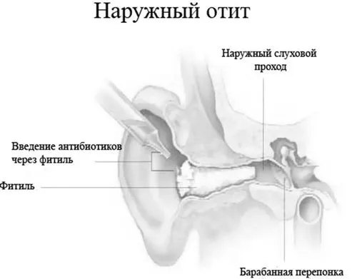 отит