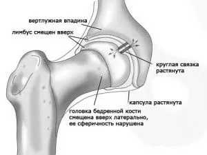 коксартрозу