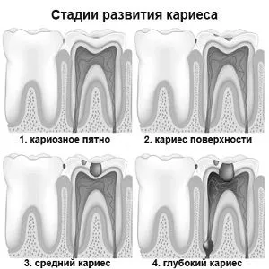 як лікувати карієс в стадії плями
