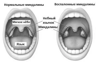 ангіни