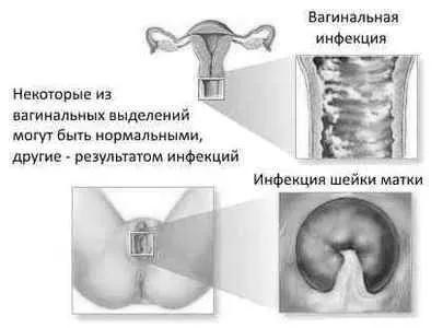 Кольпіт симптоми кольпіт