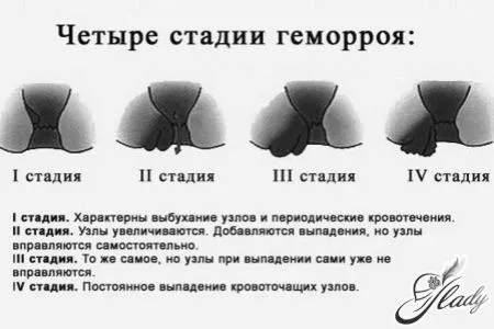 як лікувати геморой якщо годуєш грудьми