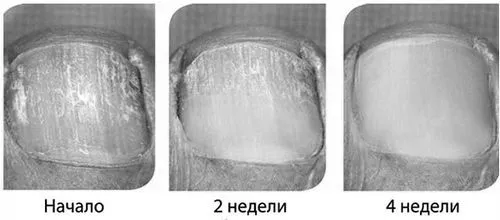 грибка