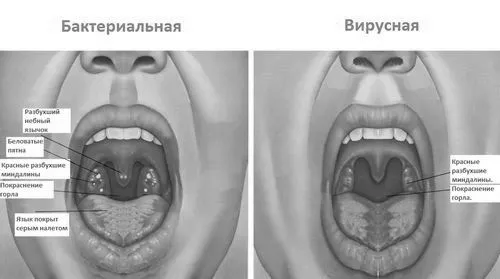 ангіни