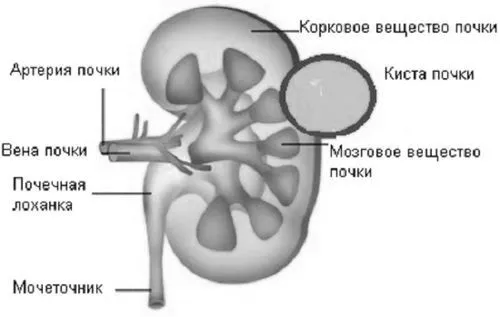 як вилікувати кісту головного мозку народними засобами