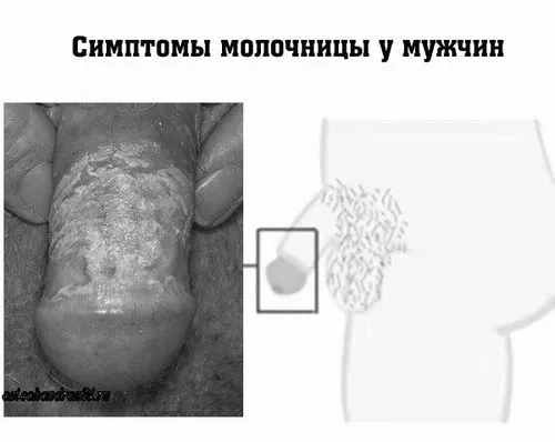 молочниці