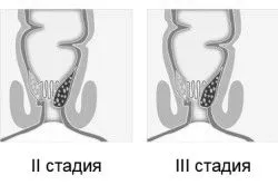геморою