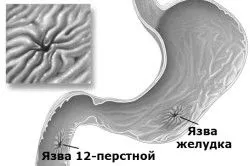 Лікування виразки шлунка травами шлунка