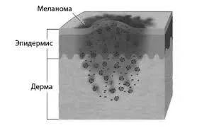 Методи лікування раку шкіри методи