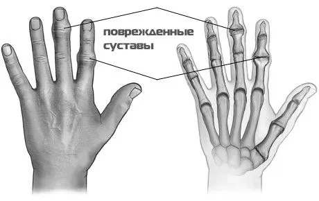 чи можна вилікувати артрит