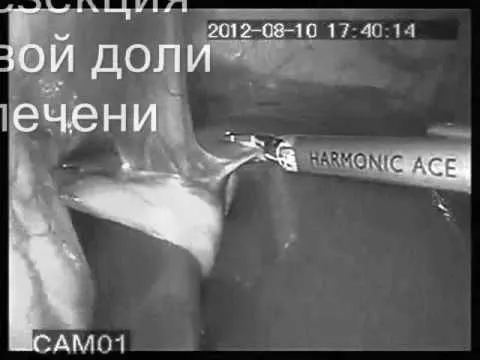 як лікувати метастази в печінці