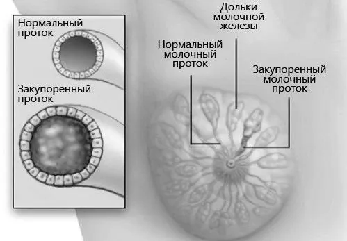 ускладнення