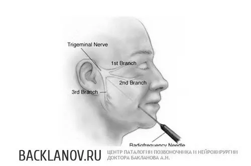 як лікувати невралгію голови