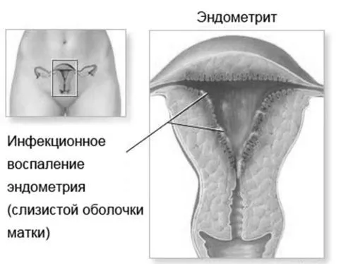 Чи можна вилікувати хронічний ендометрит можна