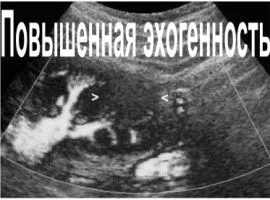ехогенність