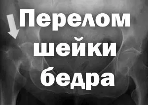 як лікувати забій шийки стегна