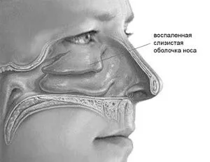 гострий