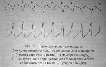 пароксизмальнатахікардія причини