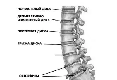 остеохондроз