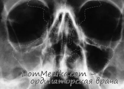Причини загострення гаймориту коли без проколу при гаймориті не обійтися