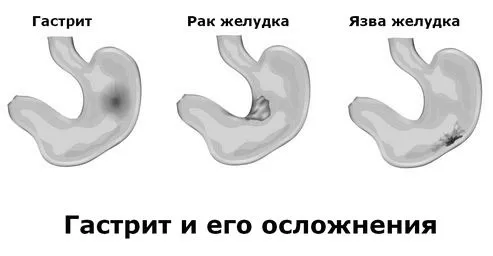 як лікувати поверхневий гастрит