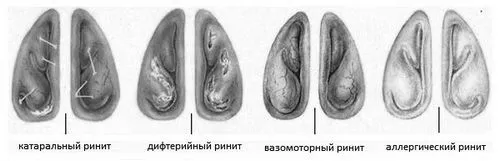 риніт нежить що це симптоми лікування види причини профілактика стадії діагностика