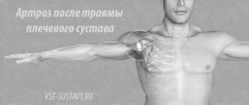 як лікувати посттравматичний артроз