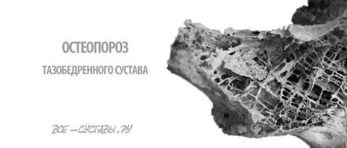 як лікувати остеопороз тазостегнового суглоба