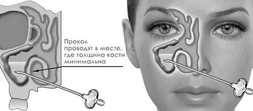 хронічний гайморит без гною